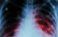 La tuberculosis vuelve a ser la enfermedad infecciosa más mortal